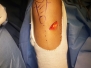 ACL RECONSTRUCTION